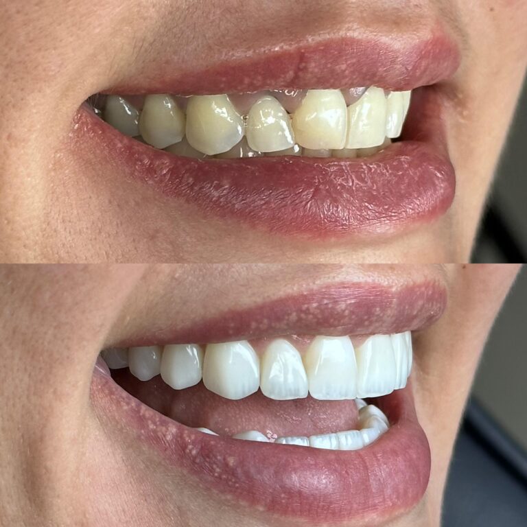 Facetas de resina e porcelana